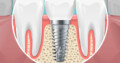 Dental Implant In Kolkata |