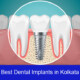 Dental Implant In Kolkata |